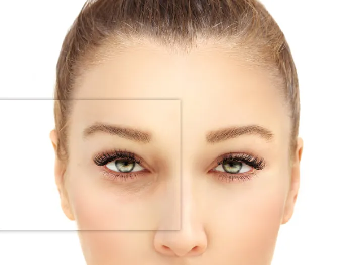 بلفاروپلاستی چیست