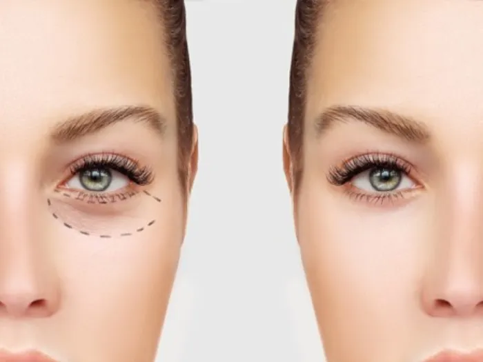 تاری دید بعد از عمل بلفاروپلاستی