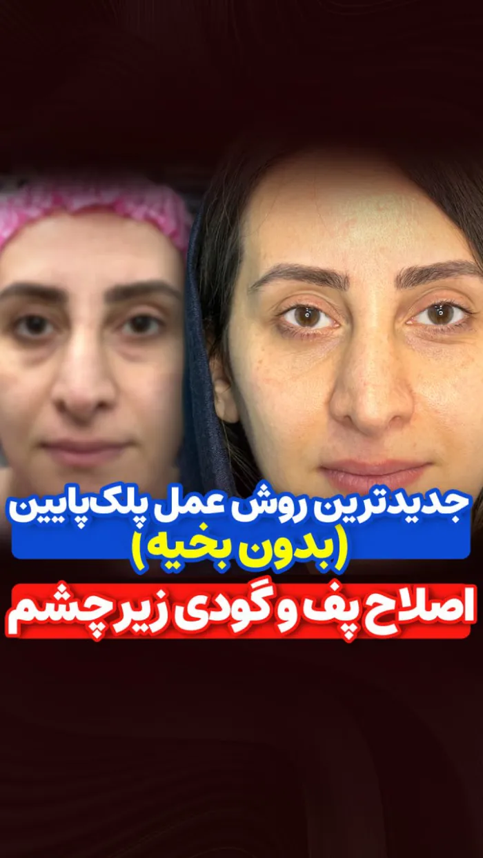 فیلم نمونه عمل اصلاح پف و گودی زیر چشم