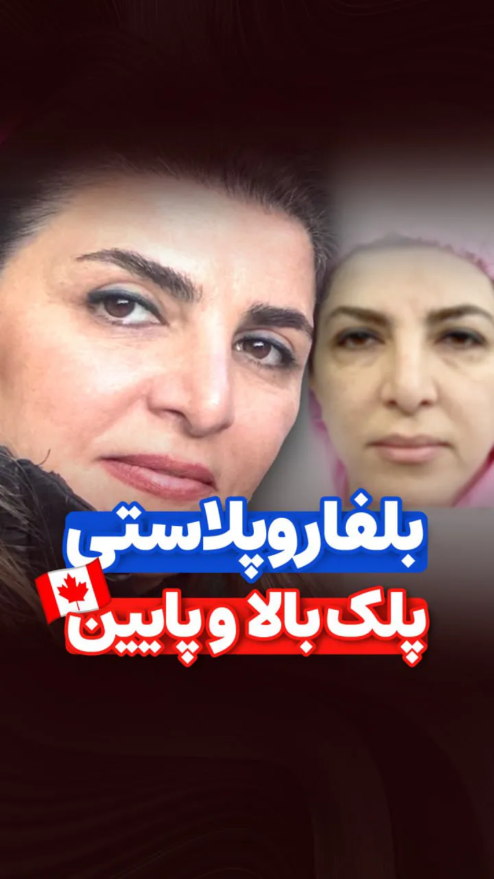 فیلم نمونه جراحی پلک بالا و پایین