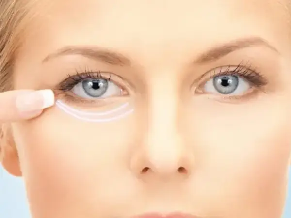 بلفاروپلاستی چشم گربه ای