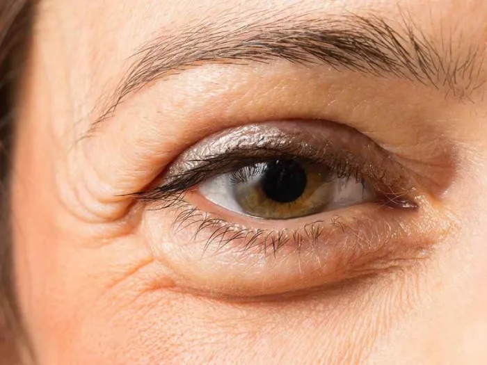 5 علت مهم افتادگی پلک بالا و پایین