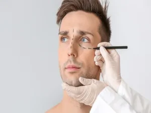 سن بلفاروپلاستی