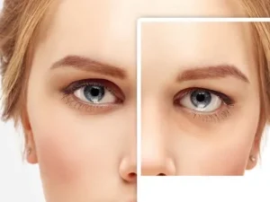 سن عمل بلفاروپلاستی