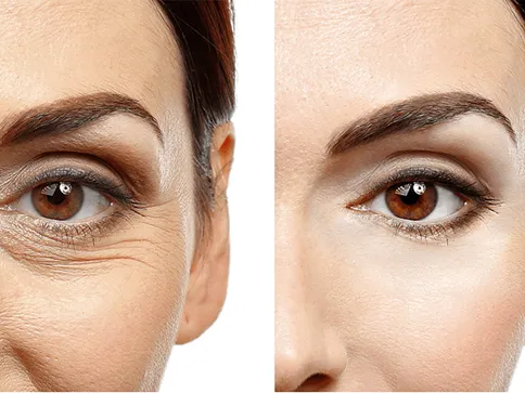 بهترین سن برای عمل بلفاروپلاستی