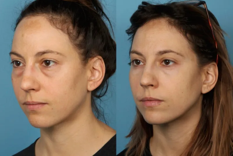 blepharoplasty