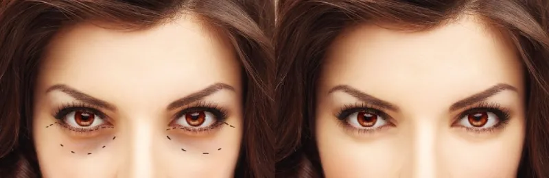 کانتوپلاستی