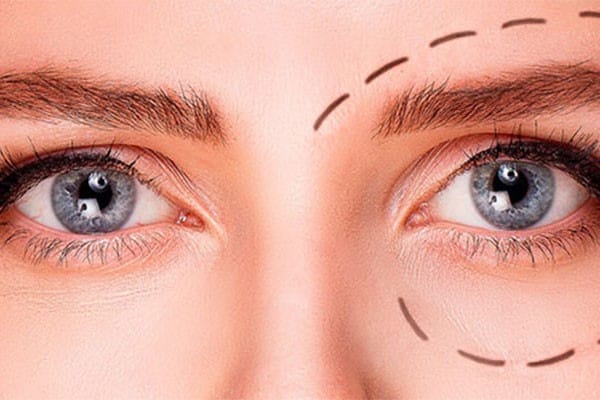 افتادگی ابرو بعد از بلفاروپلاستی