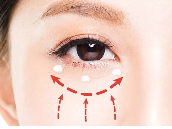 بلفاروپلاستی پلک پایین بدون بخیه