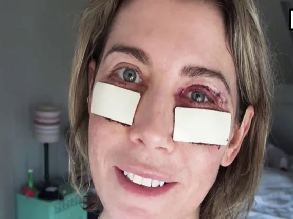 مراقبت های بعد از بلفاروپلاستی