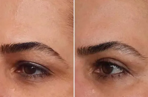 مراقبت های بلفاروپلاستی