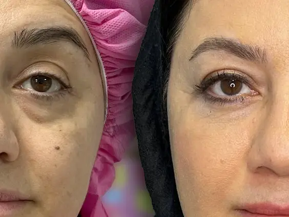 بلفاروپلاستی