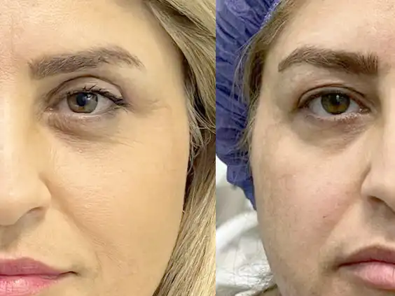 حمام کردن بعد از بلفاروپلاستی