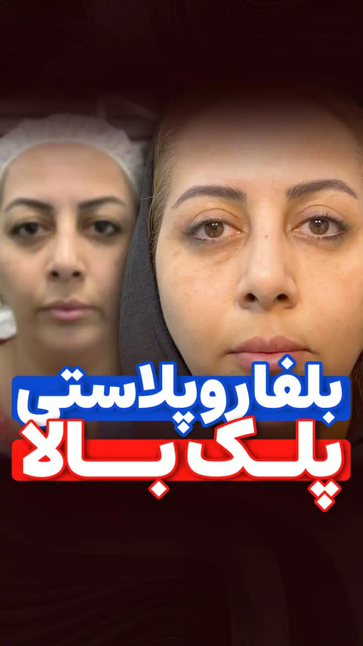 فیلم نمونه جراحی افتادگی پلک بالا