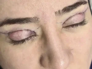 کبودی چشم بعد از بلفاروپلاستی