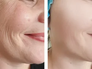 7 روش درمان خانگی چین و چروک صورت