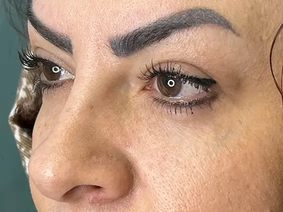 ماندگاری عمل بلفاروپلاستی