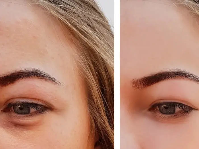 بلفاروپلاستی ۴ پلک