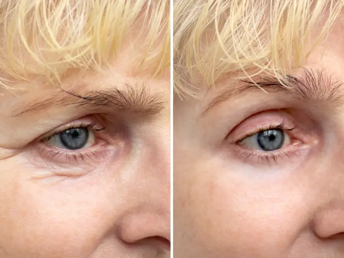 بلفاروپلاستی پلک پایین