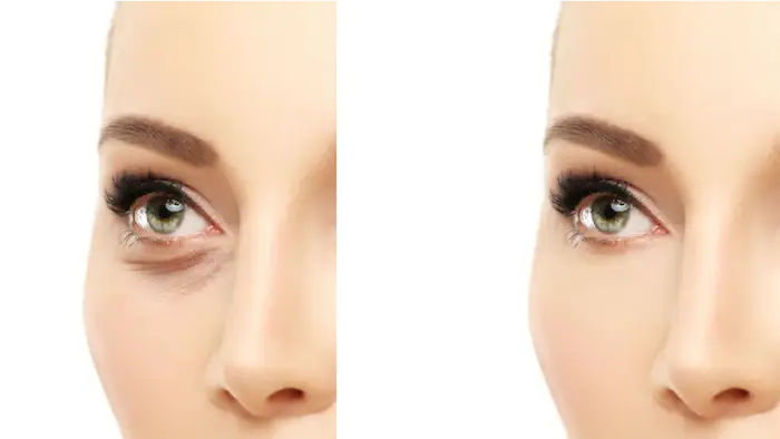 جراحی پلک پایین