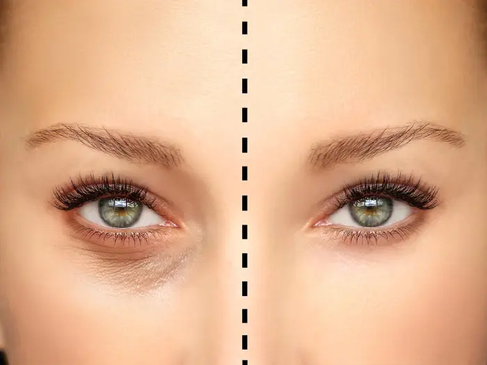 عمل بلفاروپلاستی پلک پایین بدون بخیه