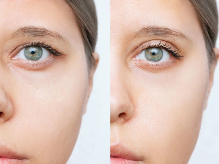 لیفت چشم چیست