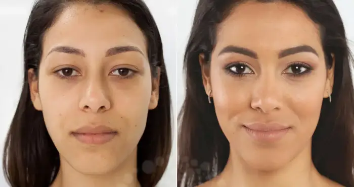 مراقبت پس از بلفاروپلاستی پلک بالا