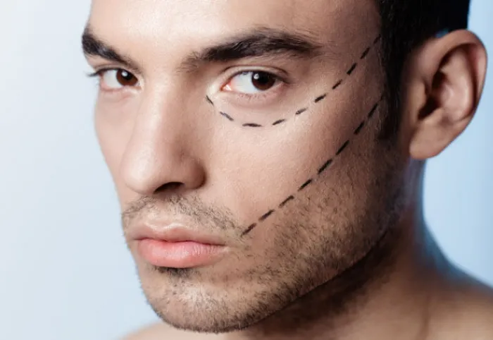 بلفاروپلاستی آقایان