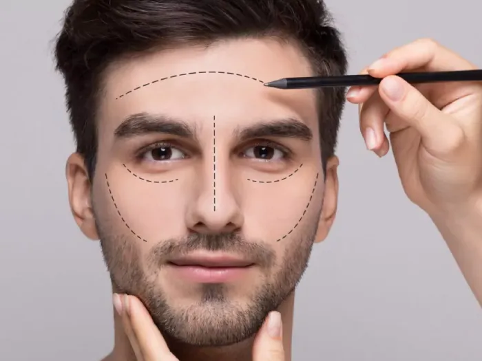 بلفاروپلاستی آقایان