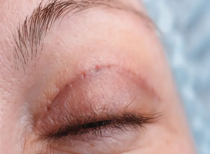 جای اسکار روی پلک