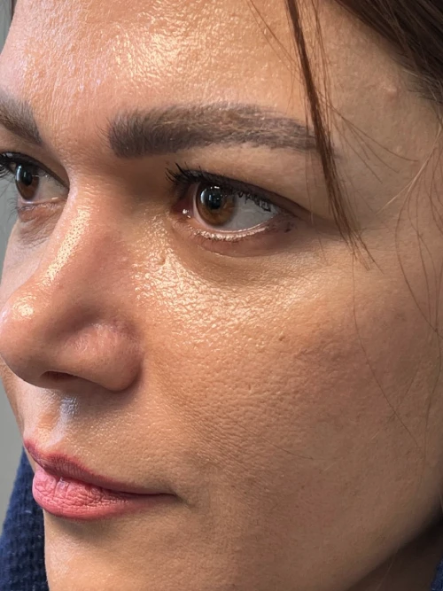 انجام بلفاروپلاستی