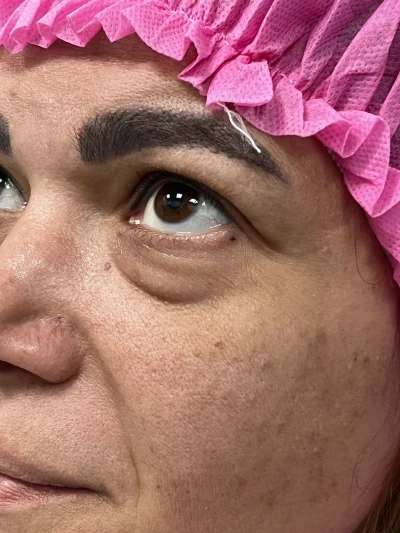 بلفاروپلاستی خانم ها