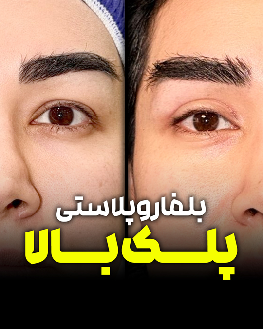 بلفاروپلاستی پلک بالا