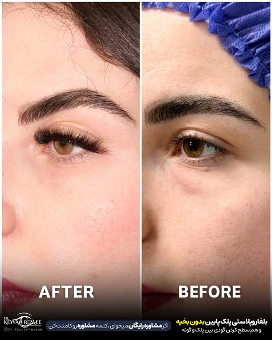 بلفاروپلاستی پلک پایین با اصلاح گودی بین پلک و گونه