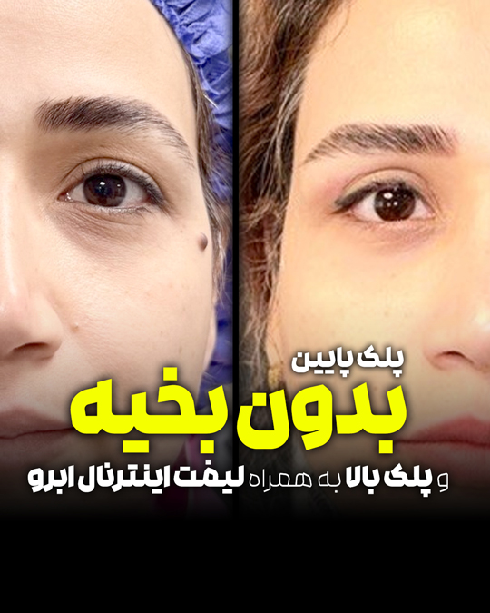ترکیب بلفاروپلاستی پلک پایین و پلک بالا و لیفت اینترنال ابرو