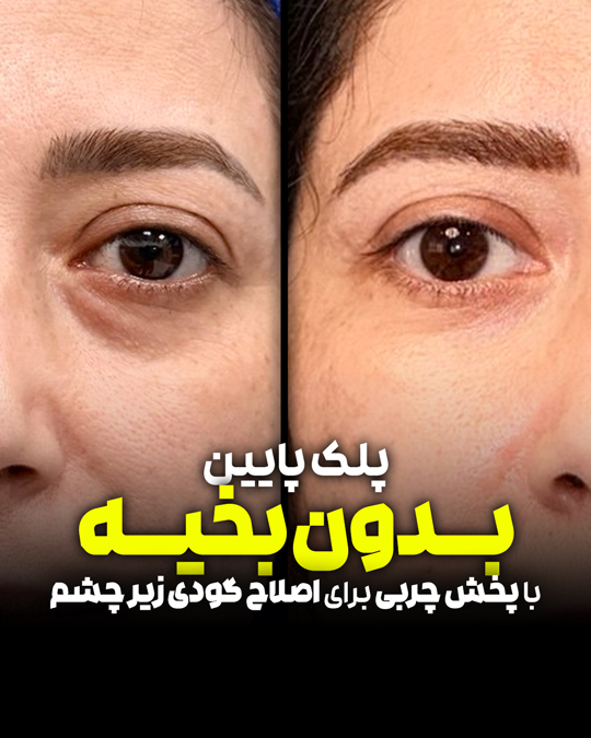 بلفاروپلاستی پلک پایین بدون بخیه