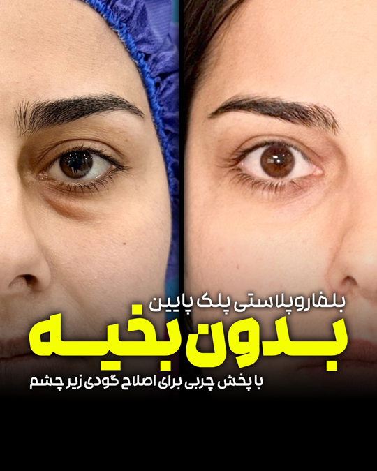 بلفاروپلاستی پلک پایین بدون بخیه