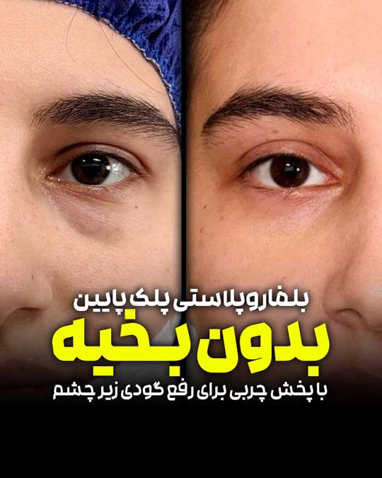 بلفاروپلاستی پلک پایین بدون برش پوستی؛ کاهش پف و بهبود ظاهر زیر چشم