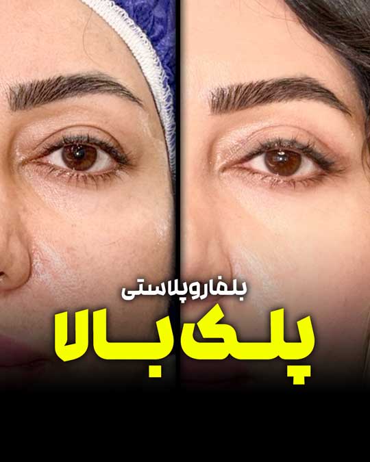 بلفاروپلاستی پلک بالا؛ اصلاح افتادگی و پوست اضافه پلک