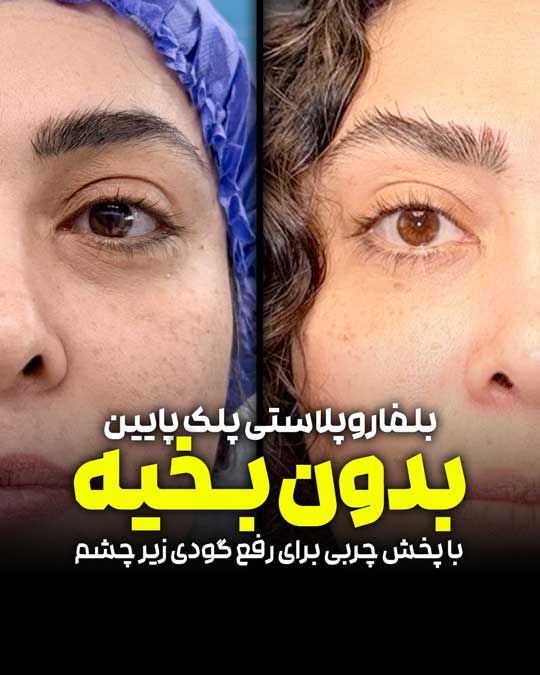 بلفاروپلاستی پلک پایین بدون برش پوستی؛ اصلاح پف و گودی زیر چشم