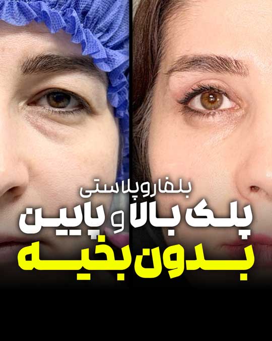 بلفاروپلاستی پلک بالا و پایین بدون برش پوستی؛ بهبود پف و فرم اطراف چشم
