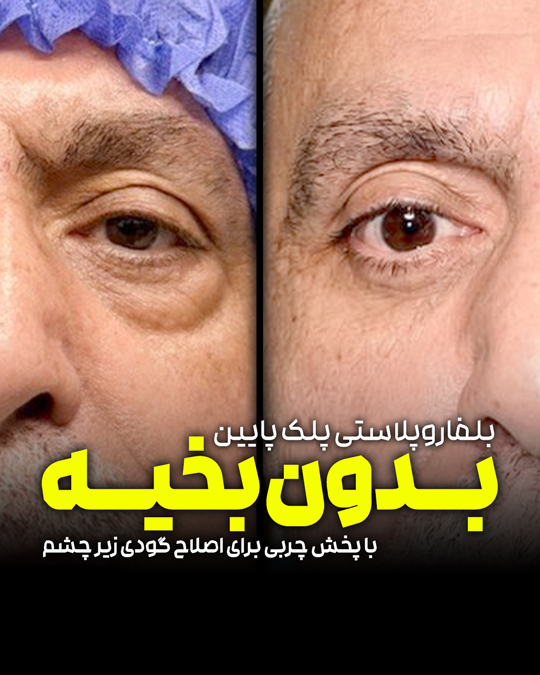 بلفاروپلاستی پلک پایین بدون برش پوستی