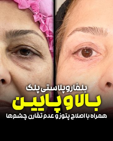 بلفاروپلاستی پلک بالا و پایین
