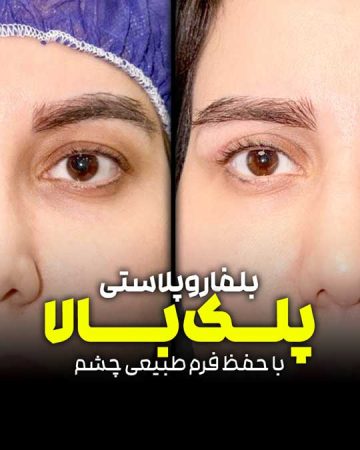 بلفاروپلاستی پلک بالا