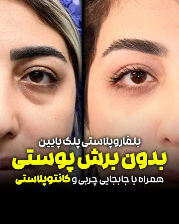 بلفاروپلاستی پلک پایین