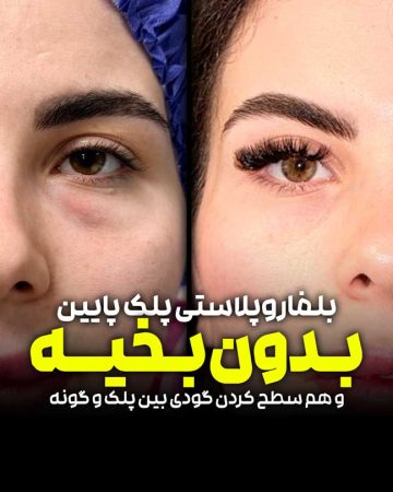 بلفاروپلاستی پلک پایین با اصلاح گودی بین پلک و گونه
